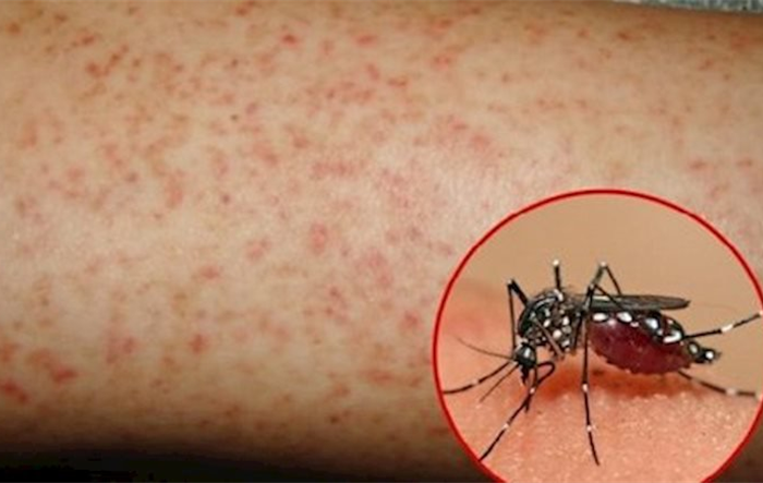 Giảm tỷ lệ mắc và tử vong do bệnh sốt xuất huyết