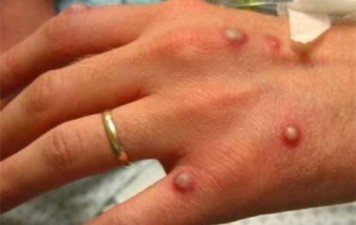 Tăng cường giám sát, phòng, chống bệnh đậu mùa khỉ