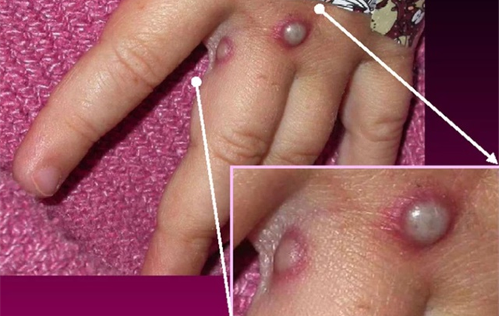 Hà Nội: Tăng cường giám sát, phòng chống bệnh đậu mùa khỉ tại các cửa khẩu, cảng hàng không