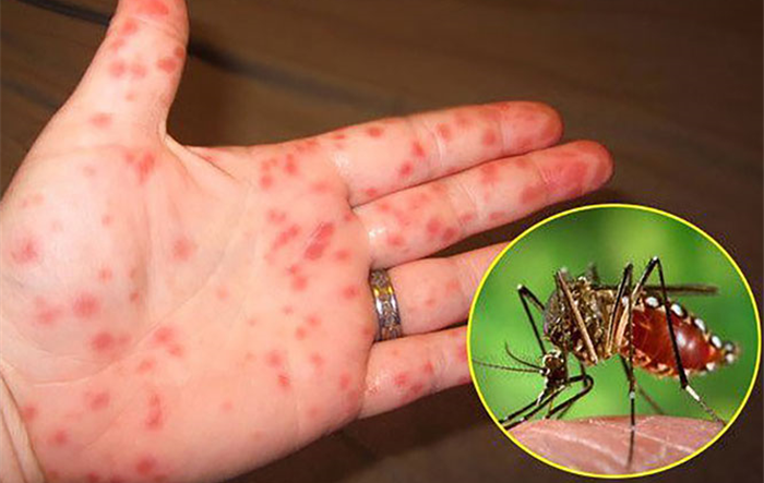 Hà Nội phân tuyến quản lý điều trị người bệnh sốt xuất huyết Dengue