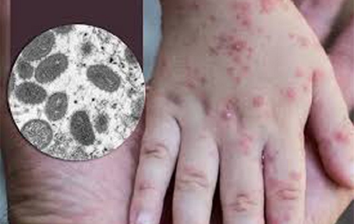 Tăng cường vận động cán bộ, nhân viên, người dân chủ động phối hợp thực hiện biện pháp phòng, chống bệnh đậu mùa khỉ