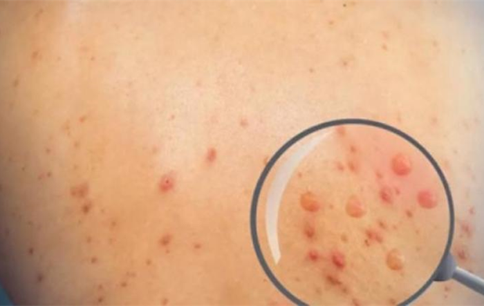 Bộ Y tế ban hành quyết định hướng dẫn tạm thời giám sát và phòng chống bệnh đậu mùa khỉ
